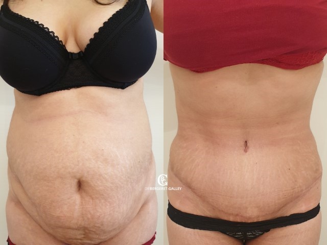 Abdominoplastie, cas 61, photographie avant et après