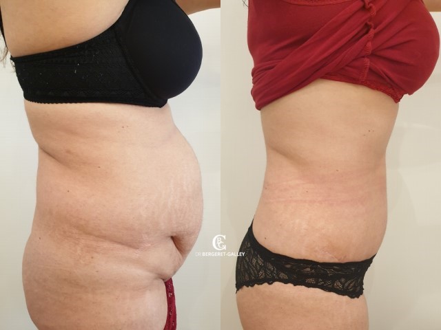 Abdominoplastie, cas 62, photographie avant et après