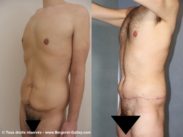 Bodylift, cas 2, photographie avant et après