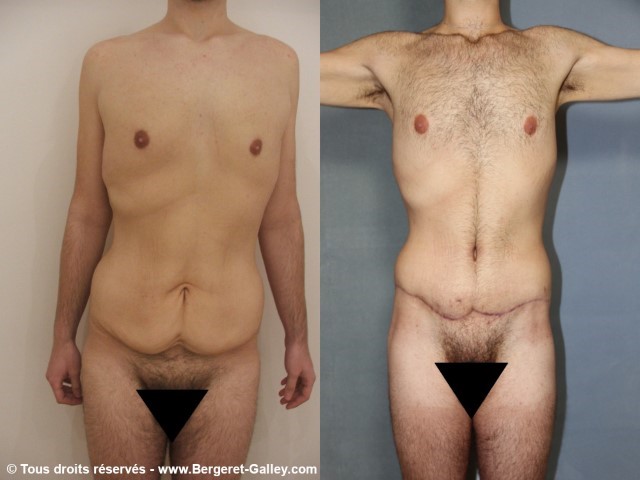 Bodylift, cas 3, photographie avant et après