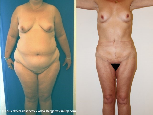 Bodylift, cas 5, photographie avant et après