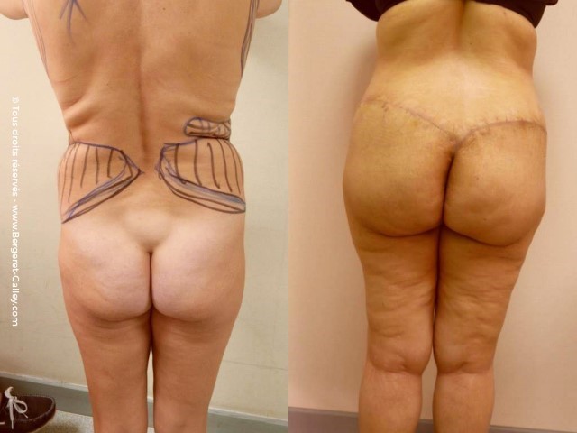 Bodylift, cas 6, photographie avant et après