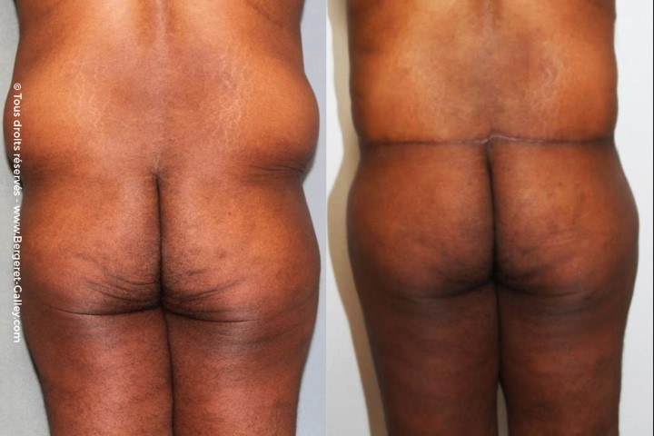 Bodylift, cas 7, photographie avant et après
