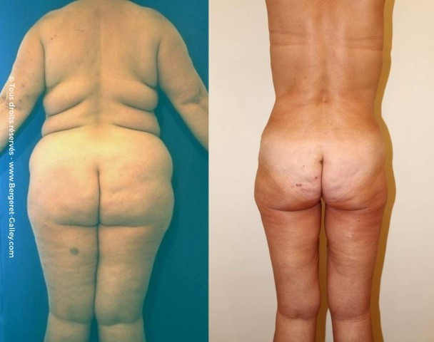 Bodylift, cas 8, photographie avant et après
