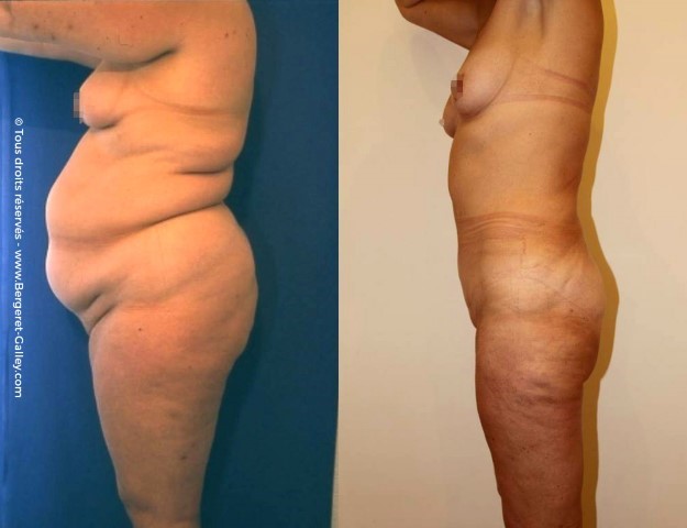 Bodylift, cas 9, photographie avant et après