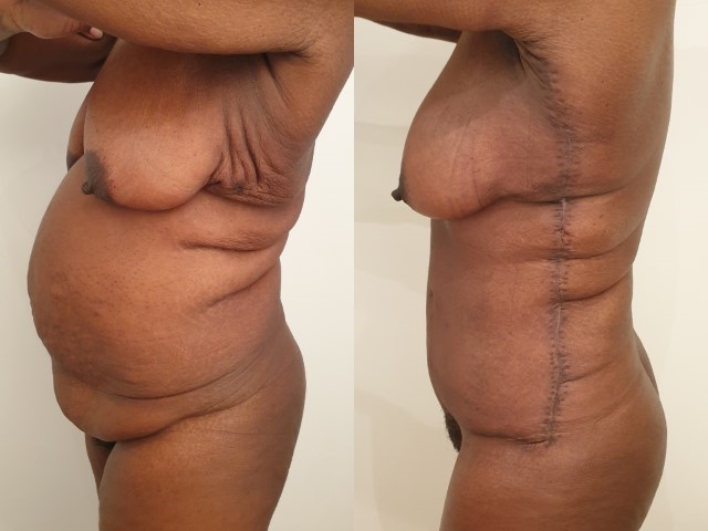 Bodylift, cas 10, photographie avant et après