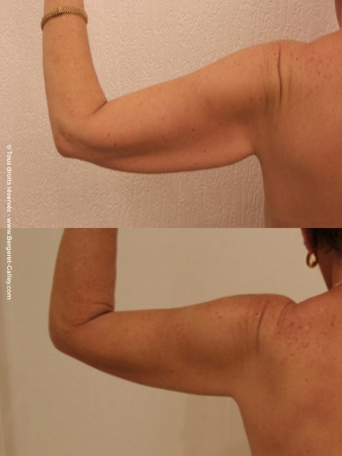 Lifting des bras (brachioplastie), cas 1, photographie avant et après