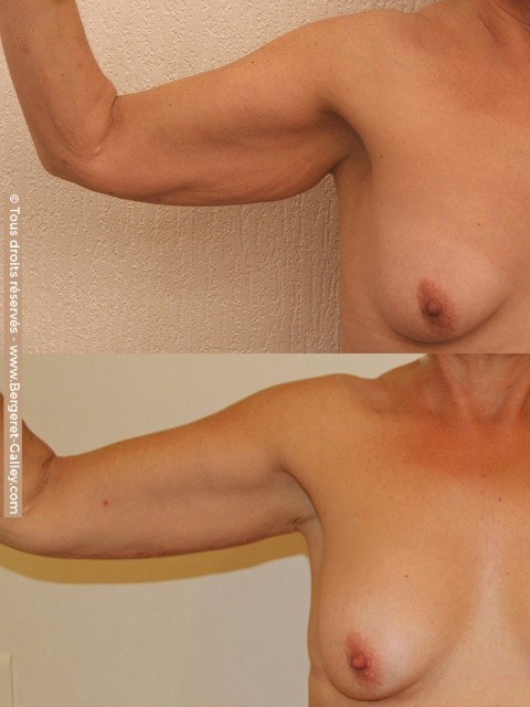 Lifting des bras (brachioplastie), cas 2, photographie avant et après