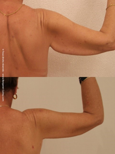 Lifting des bras (brachioplastie), cas 4, photographie avant et après