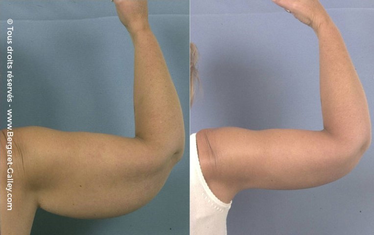 Lifting des bras (brachioplastie), cas 5, photographie avant et après