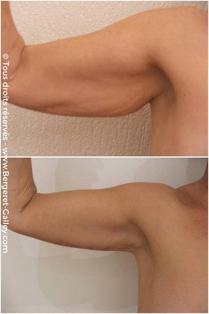 Lifting des bras (brachioplastie), cas 6, photographie avant et après