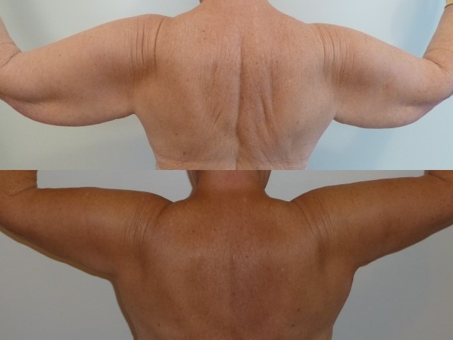 Lifting des bras (brachioplastie), cas 7, photographie avant et après
