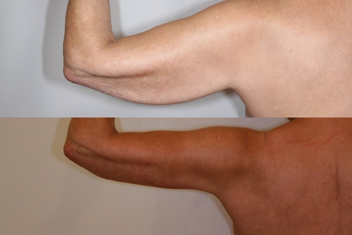 Lifting des bras (brachioplastie), cas 8, photographie avant et après