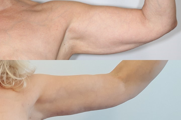 Lifting des bras (brachioplastie), cas 9, photographie avant et après