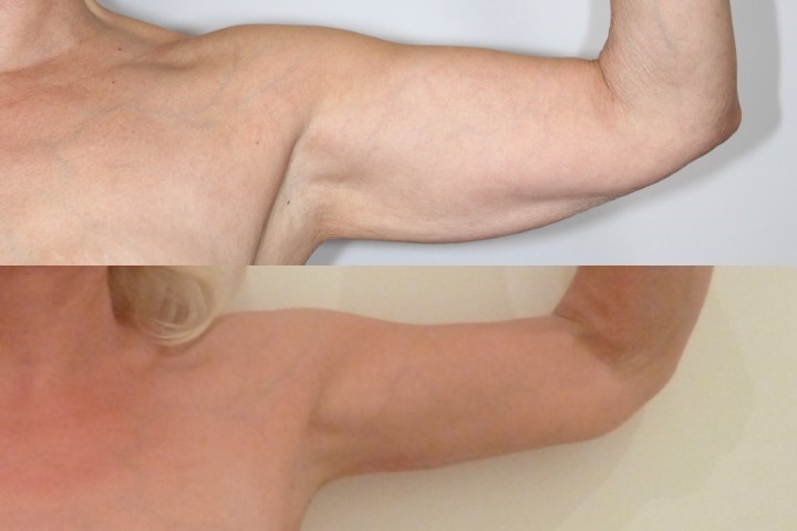 Lifting des bras (brachioplastie), cas 10, photographie avant et après