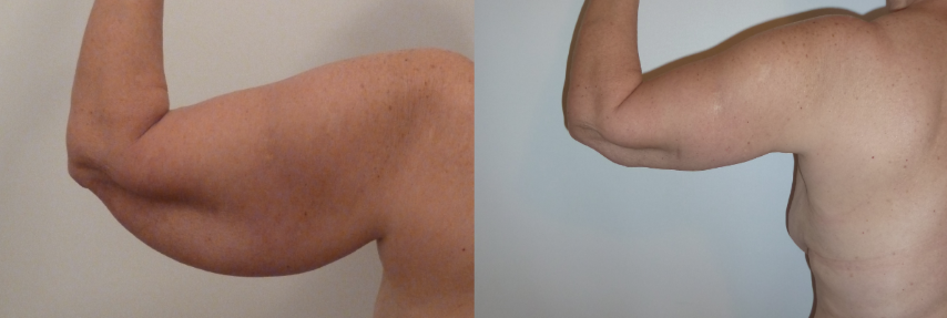 Lifting des bras (brachioplastie), cas 11, photographie avant et après