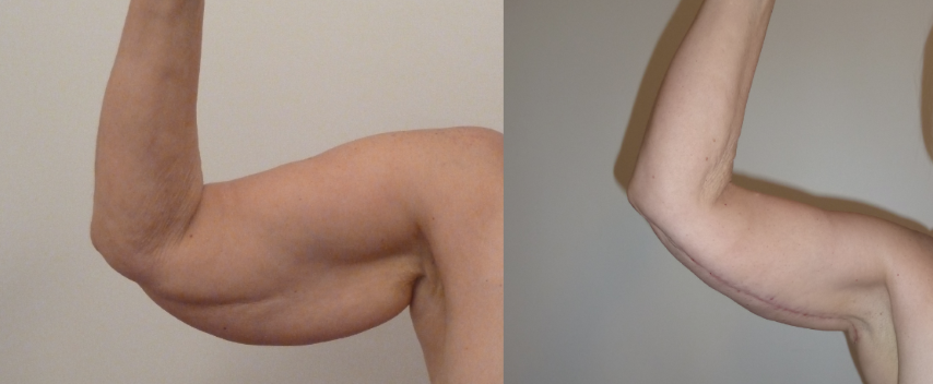 Lifting des bras (brachioplastie), cas 12, photographie avant et après