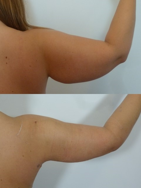 Lifting des bras (brachioplastie), cas 13, photographie avant et après