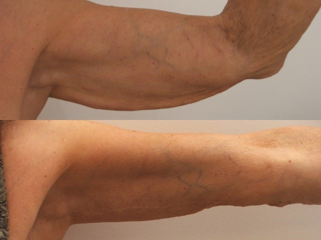 Lifting des bras (brachioplastie), cas 14, photographie avant et après