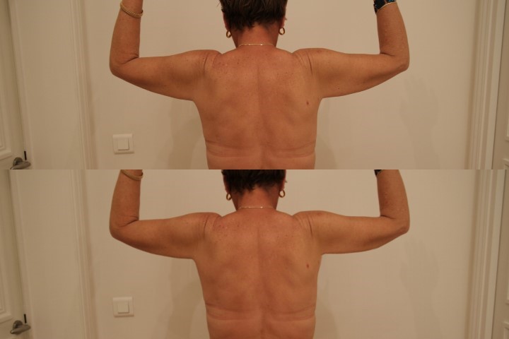 Lifting des bras (brachioplastie), cas 15, photographie avant et après