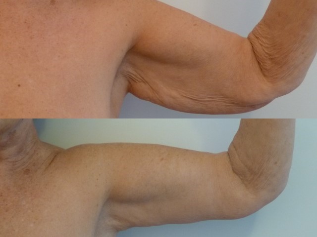 Lifting des bras (brachioplastie), cas 16, photographie avant et après