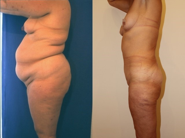 Lifting des cuisses, cas 5, photographie avant et après