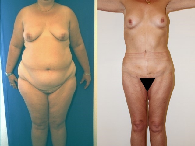 Lifting des cuisses, cas 6, photographie avant et après