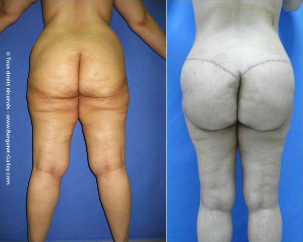 Lifting des fesses, cas 1, photographie avant et après
