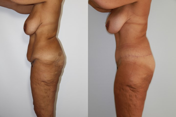 Lifting des fesses, cas 3, photographie avant et après