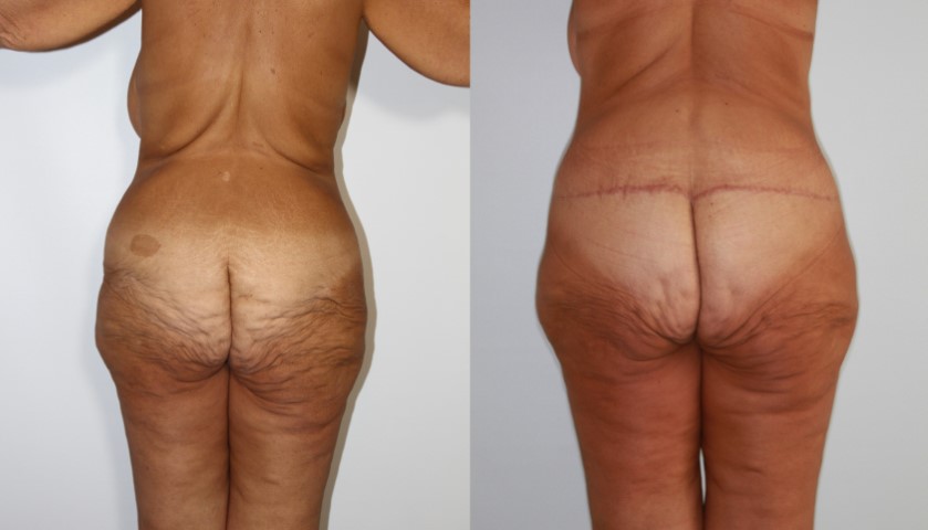 Lifting des fesses, cas 5, photographie avant et après