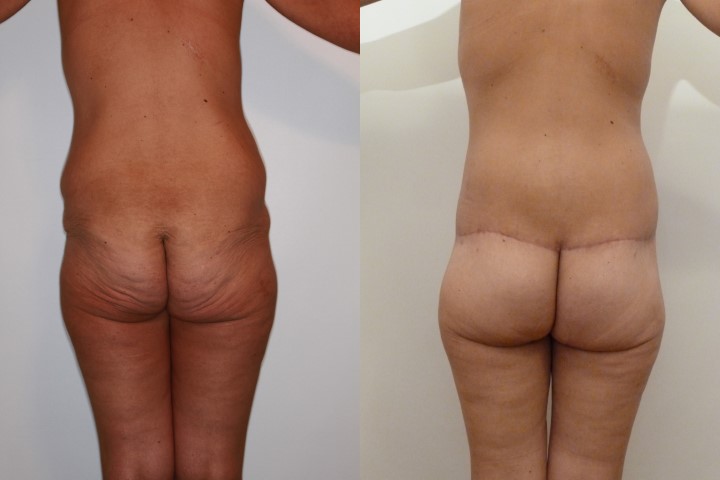 Lifting des fesses, cas 7, photographie avant et après