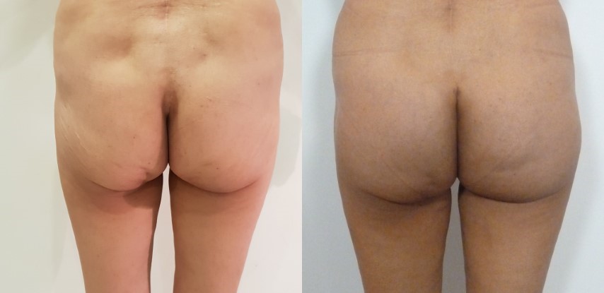 Lifting des fesses, cas 8, photographie avant et après