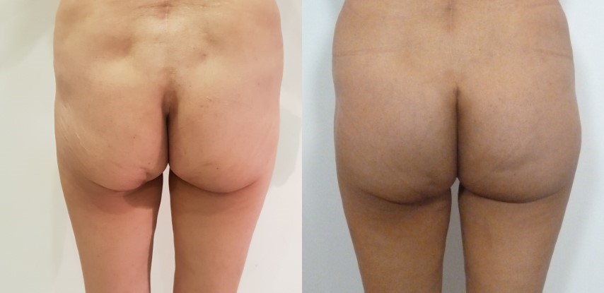 Lifting des fesses, cas 9, photographie avant et après