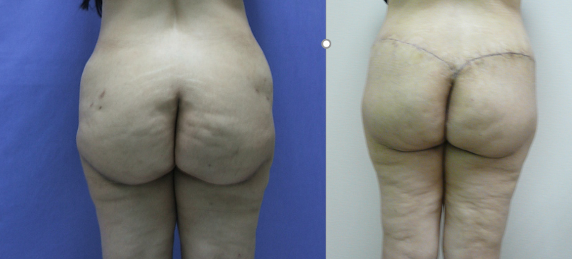 Lifting des fesses, cas 11, photographie avant et après