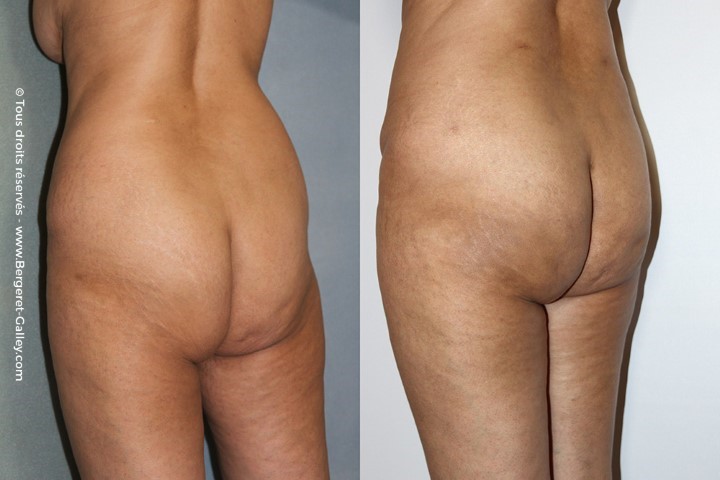 Lipofilling des fesses, cas 1, photographie avant et après