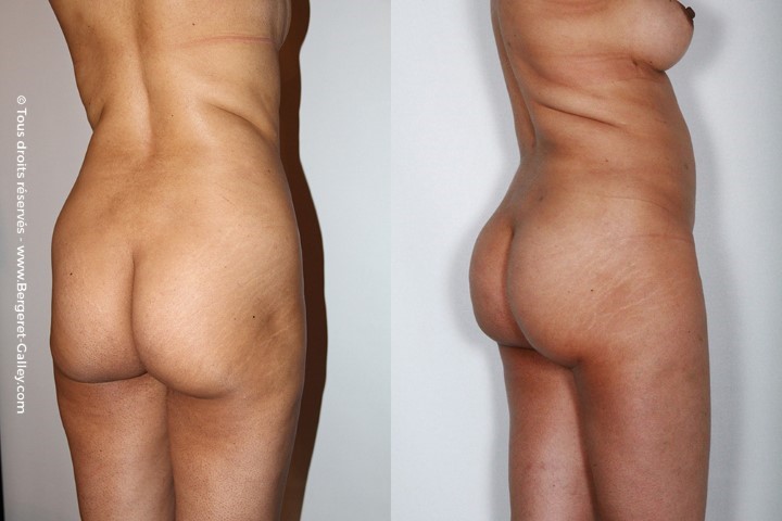 Lipofilling des fesses, cas 2, photographie avant et après