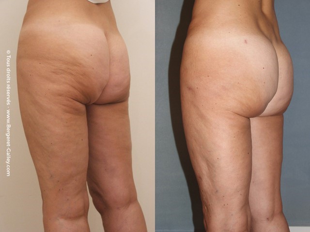 Lipofilling des fesses, cas 3, photographie avant et après