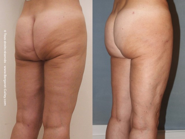 Lipofilling des fesses, cas 4, photographie avant et après