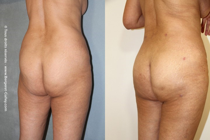 Lipofilling des fesses, cas 5, photographie avant et après