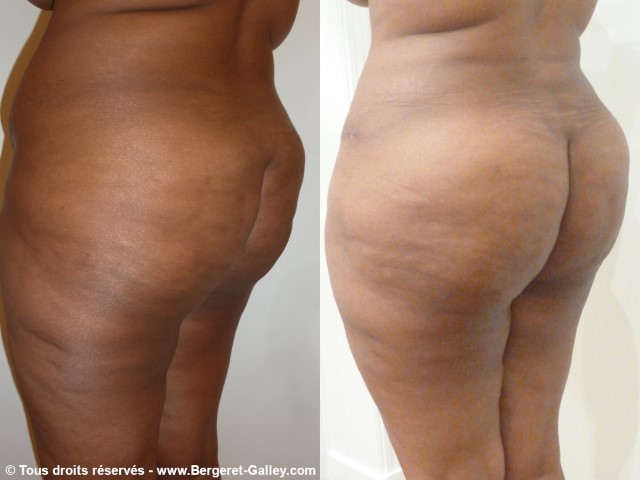 Lipofilling des fesses, cas 6, photographie avant et après