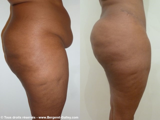 Lipofilling des fesses, cas 7, photographie avant et après