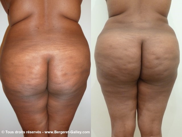 Lipofilling des fesses, cas 8, photographie avant et après