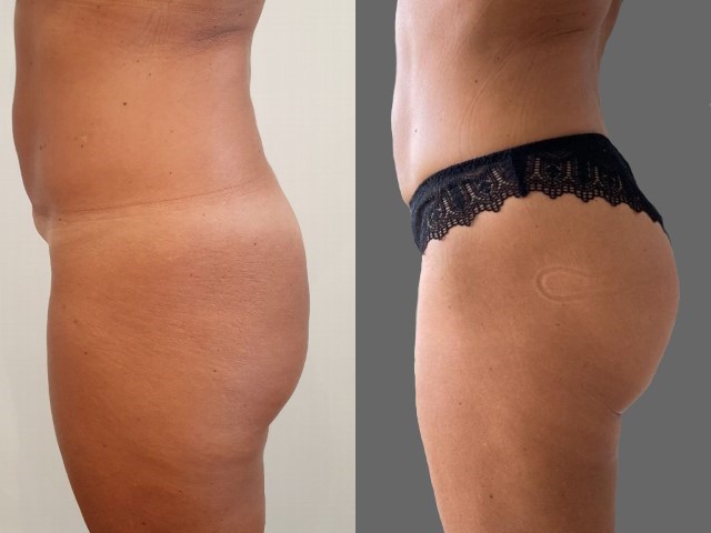 Lipofilling des fesses, cas 10, photographie avant et après