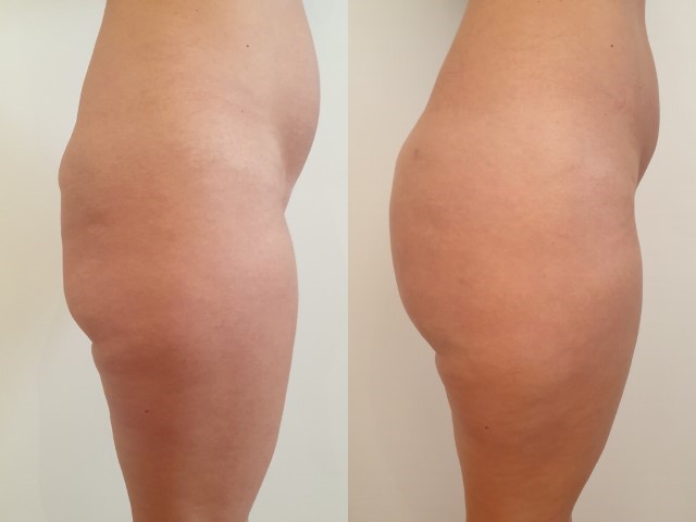 Lipofilling des fesses, cas 11, photographie avant et après