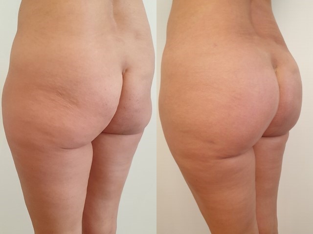 Lipofilling des fesses, cas 12, photographie avant et après