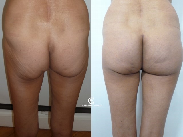 Lipofilling des fesses, cas 13, photographie avant et après