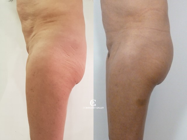 Lipofilling des fesses, cas 14, photographie avant et après