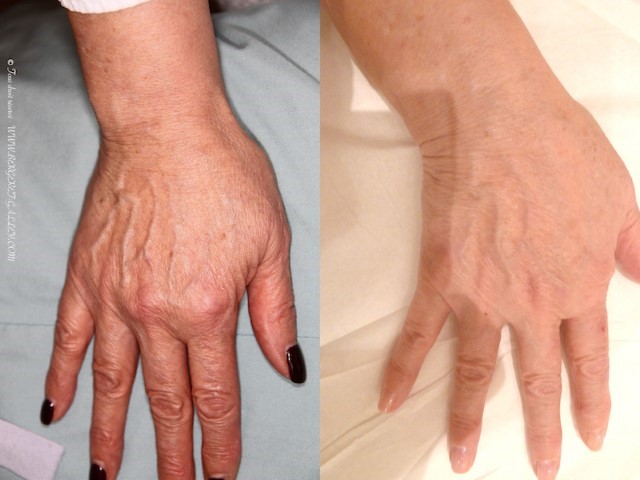 Lipofilling des mains, cas 1, photographie avant et après