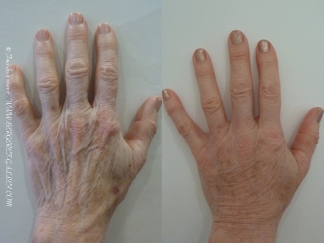 Lipofilling des mains, cas 2, photographie avant et après