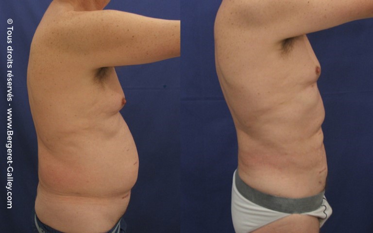 Liposuccion, cas 1, photographie avant et après